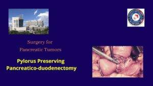 Open Pylorus Preserving Pancreaticoduodenectomy