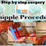 Step by step Open Whipple Pancreaticoduodenectomy.