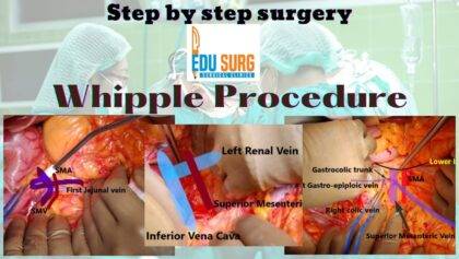 Step by step Open Whipple Pancreaticoduodenectomy.