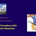 Open Pancreaticoduodenectomy (Whipples procedure) with portal vein resection for Pancreatic Head CA