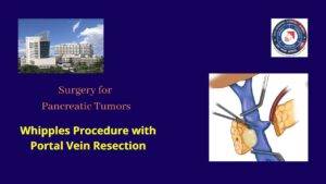 Open Pancreaticoduodenectomy (Whipples procedure) with portal vein resection for Pancreatic Head CA