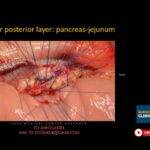 Surgical Anatomy & Operative Steps of Whipples Pancreaticoduodenectomy