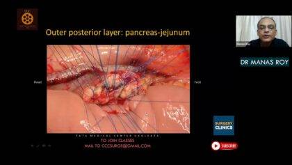 Surgical Anatomy & Operative Steps of Whipples Pancreaticoduodenectomy
