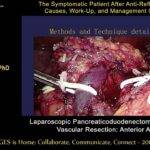 Laparoscopic pancreaticoduodenectomy with major venous resection: Anterior SMA first approach, SAGES 2018