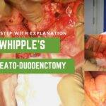 Open Whipples Pancreaticoduodenectomy for Head of Pancreas Carcinoma