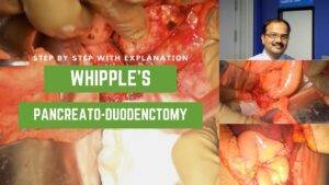 Open Whipples Pancreaticoduodenectomy for Head of Pancreas Carcinoma