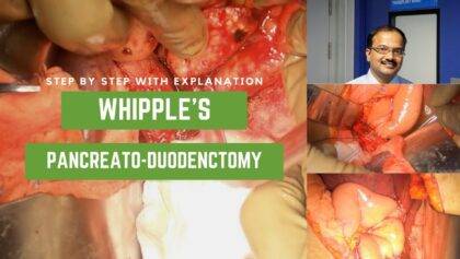 Open Whipples Pancreaticoduodenectomy for Head of Pancreas Carcinoma