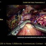 Laparoscopic pancreatoduodenectomy using Artery (SMA) first approach