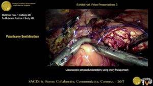 Laparoscopic pancreatoduodenectomy using Artery (SMA) first approach