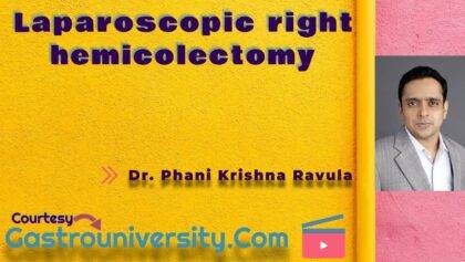 Colon-Laparoscopic Right Hemicolectomy