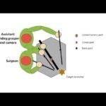 Laparoscopic Sigmoid Colectomy