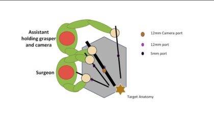 Laparoscopic Sigmoid Colectomy