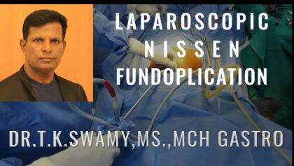 Laparoscopic Nissen Fundoplication