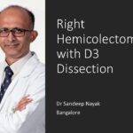 Hemicolectomy D3 dissection Colonic Cancer- gastrouniversity.com