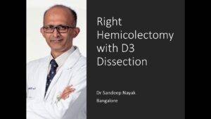 Hemicolectomy D3 dissection Colonic Cancer- gastrouniversity.com