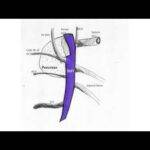 Laparoscopic Right Hemicolectomy D3 dissection