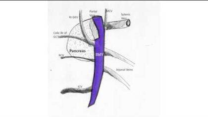 Laparoscopic Right Hemicolectomy D3 dissection