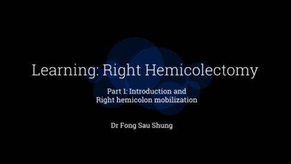 Laparoscopic Right Hemicolectomy - Three approaches of mobilisation
