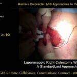 Laparoscopic right colectomy - extracorporeal anastomosis
