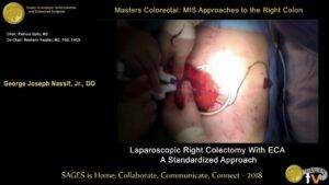 Laparoscopic right colectomy - extracorporeal anastomosis