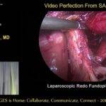 Redo fundoplication