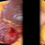 Laparoscopic right colectomy - medial to lateral approach step