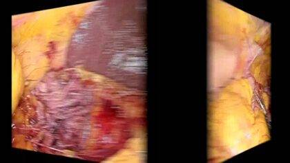 Laparoscopic right colectomy - medial to lateral approach step