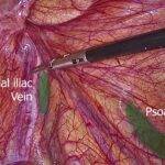 Laparoscopic Anatomy of Inguinal Hernia
