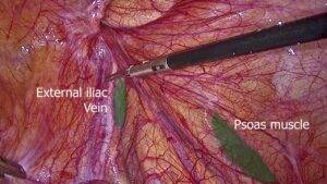 Laparoscopic Anatomy of Inguinal Hernia