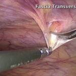 TAPP for Indirect Inguinal Hernia