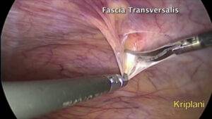 TAPP for Indirect Inguinal Hernia