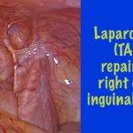 TAPP for Direct Right Inguinal Hernia