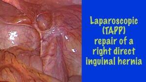 TAPP for Direct Right Inguinal Hernia