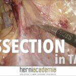 TAPP for Direct Inguinal Hernia