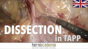 TAPP for Direct Inguinal Hernia